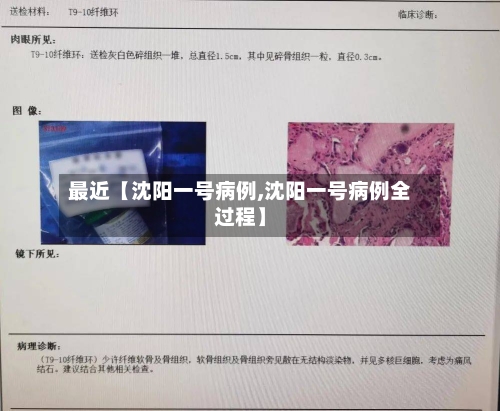 最近【沈阳一号病例,沈阳一号病例全过程】